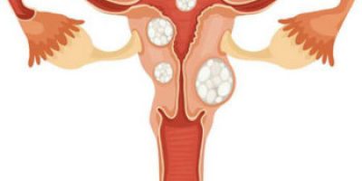 Fibroid & cyst