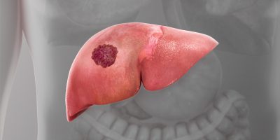 Liver-Cancer