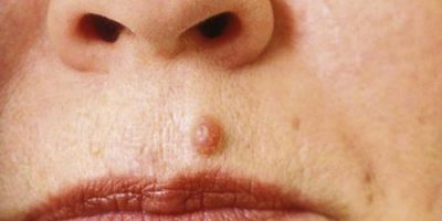 Nodule & carcinoma