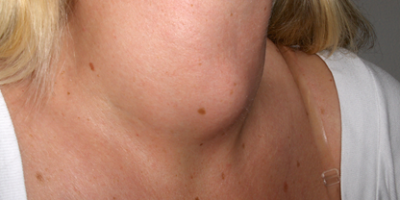 throat cancer