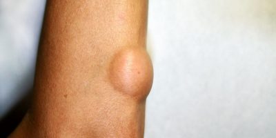 tumor